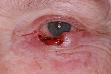 Left lower eyelid Mohs' Defect