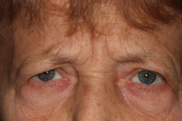 Female pre-op blepharoplasty and brow lift with brow descent and excess upper eyelid skin