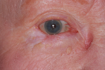 Post-op 3 months right lower eyelid reconstruction