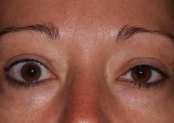 Right Upper Eyelid Retraction, pre-op