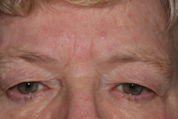 Female pre-op blepharoplasty and brow lift with excess upper eyelid skin