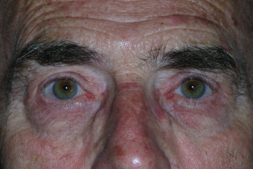 Male post-op ptosis and blepharoplasty with improved eyelid height