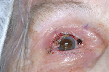 Intraoperative photograph right upper eyelid reconstruction with semicircular flap
