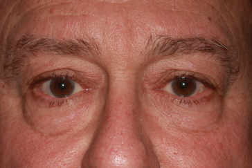 Male pre-op brow lift with brow descent