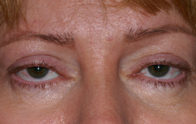 Female pre-op ptosis and blepharoplasty with drooping eyelids and excess skin