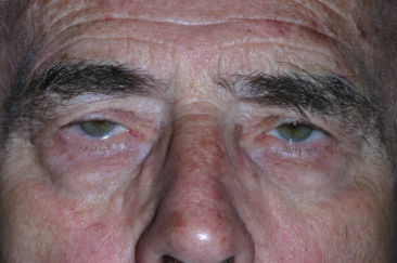Male pre-op ptosis and blepharoplasty with excess upper eyelid skin and drooping eyelids