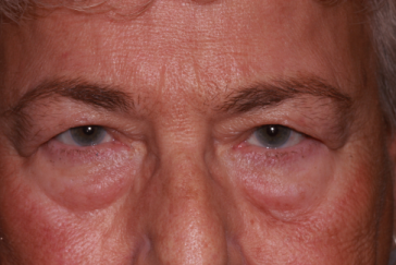 Female pre-op blepharoplasty and brow lift with heavy upper eyelids and excess lower eyelid fat