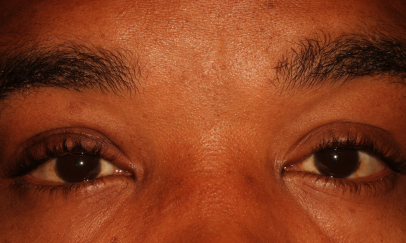 Male post-op ptosis with improved eyelid height