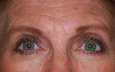 Female post-op ptosis and upper and lower blepharoplasty with improved upper eyelid height and fullness