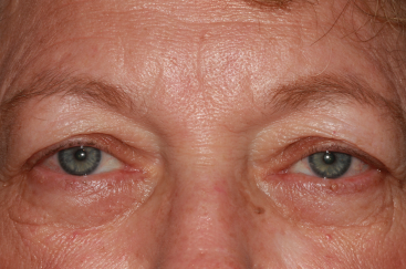 Female pre-op blepharoplasty and brow lift with brow descent and excess upper eyelid skin