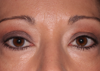 Right upper eyelid after retraction repair