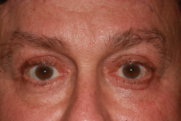 Male post-op brow lift with improved brow position