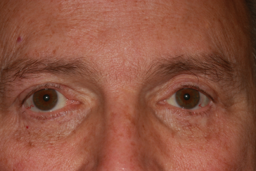 Male post-op ptosis and blepharoplasty with reduced eyelid fullness and improved eyelid height