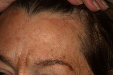 Left Side Pretrichial Scar