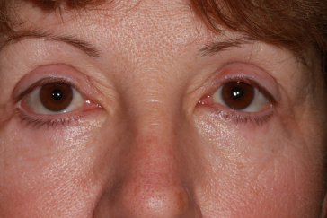 Female post-op ptosis, blepharoplasty and brow lift with improved eyelid and brow position