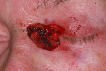 Pre-op left medial canthus Mohs' defect