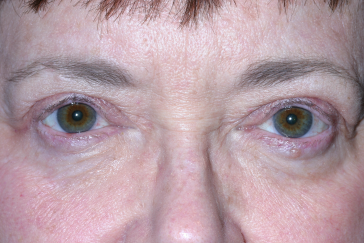 Female post-op ptosis with improved eyelid height