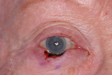 Mohs' defect right lower eyelid