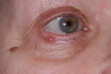 Pre-op recurrent apocrine cystadenoma right lower eyelid