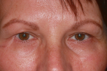 Post-op semicircular flap scar at 6 months right upper eyelid