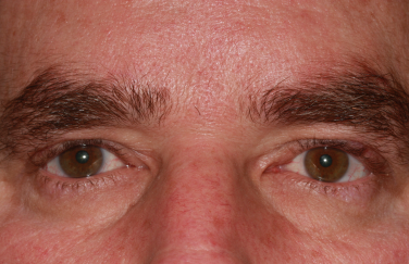 Male post-op ptosis repair and blepharoplasty with improved eyelid position
