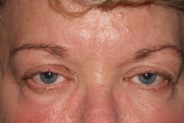 Female pre-op ptosis and brow lift with drooping upper eyelids and brows