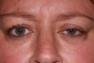 Female pre-op ptosis with drooping left upper eyelid