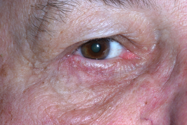 Post-op entropion surgery with improved right lower eyelid position