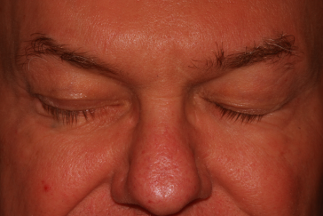 Male post-op ectropion with improved lower eyelid position, eyelid closure is complete