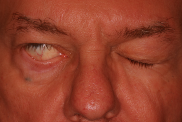 Male pre-op ectropion with right lower eyelid ectropion and incomplete lid closure