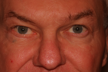 Male post-op ectropion with improved lower eyelid position
