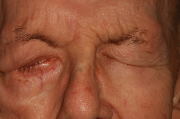 Post-op ectropion with improved right eye closure