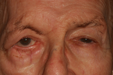 Post-op ectropion with improved right lower eyelid position