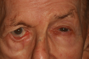 Pre-op ectropion with right lower eyelid rotation