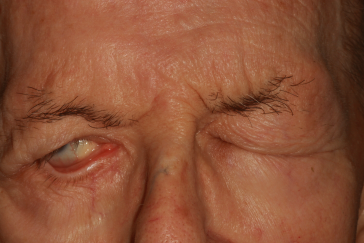 Pre-op ectropion with right lower eyelid rotation and incomplete lid closure