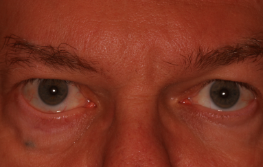 Male pre-op ectropion with right lower eyelid ectropion and eyelid retraction