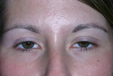 Female pre-op ptosis repair with drooping upper eyelids