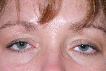 Female pre-op ptosis with drooping upper eyelids