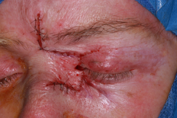 Intraoperative photograph left glabellar flap bifurcation