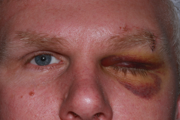 Pre-op left orbital fracture repair after baseball to the left eye