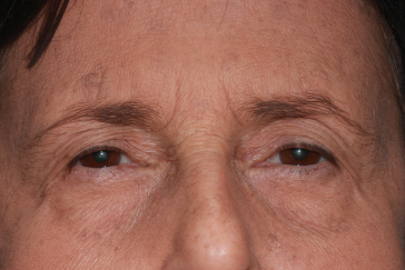 Female pre-op ptosis and blepharoplasty with drooping upper eyelids and excess skin