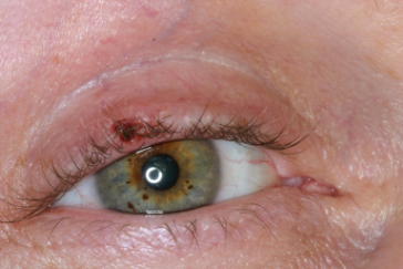 Pre-op squamous cell carcinoma right upper eyelid