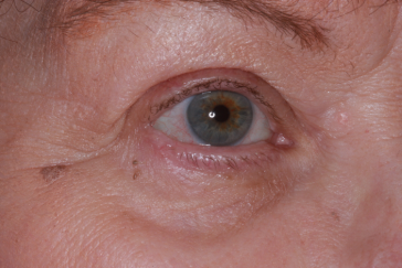 Post-op 4 months after repair right lower eyelid