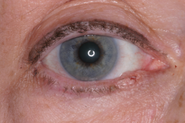 Pre-op right lower eyelid basal cell carcinoma