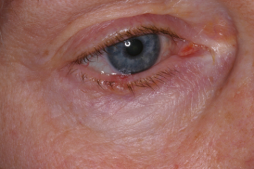 Basal cell carcinoma right lower eyelid
