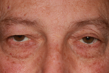 Male pre-op ptosis and blepharoplasty with excess upper eyelid skin, drooping eyelids and lower eyelid fullness