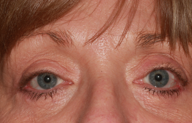 Female post-op ptosis repair and upper and lower blepharoplasty with improved eyelid height and contour