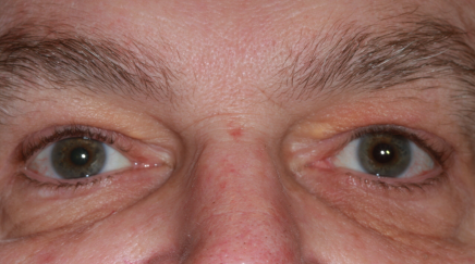 Male post-op ptosis repair, upper blepharoplasty and brow lift with improved eyelid position