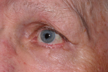 Post-op 3 months after repair, left lower eyelid