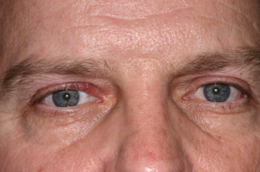 Post-op 6 weeks right upper eyelid reconstruction